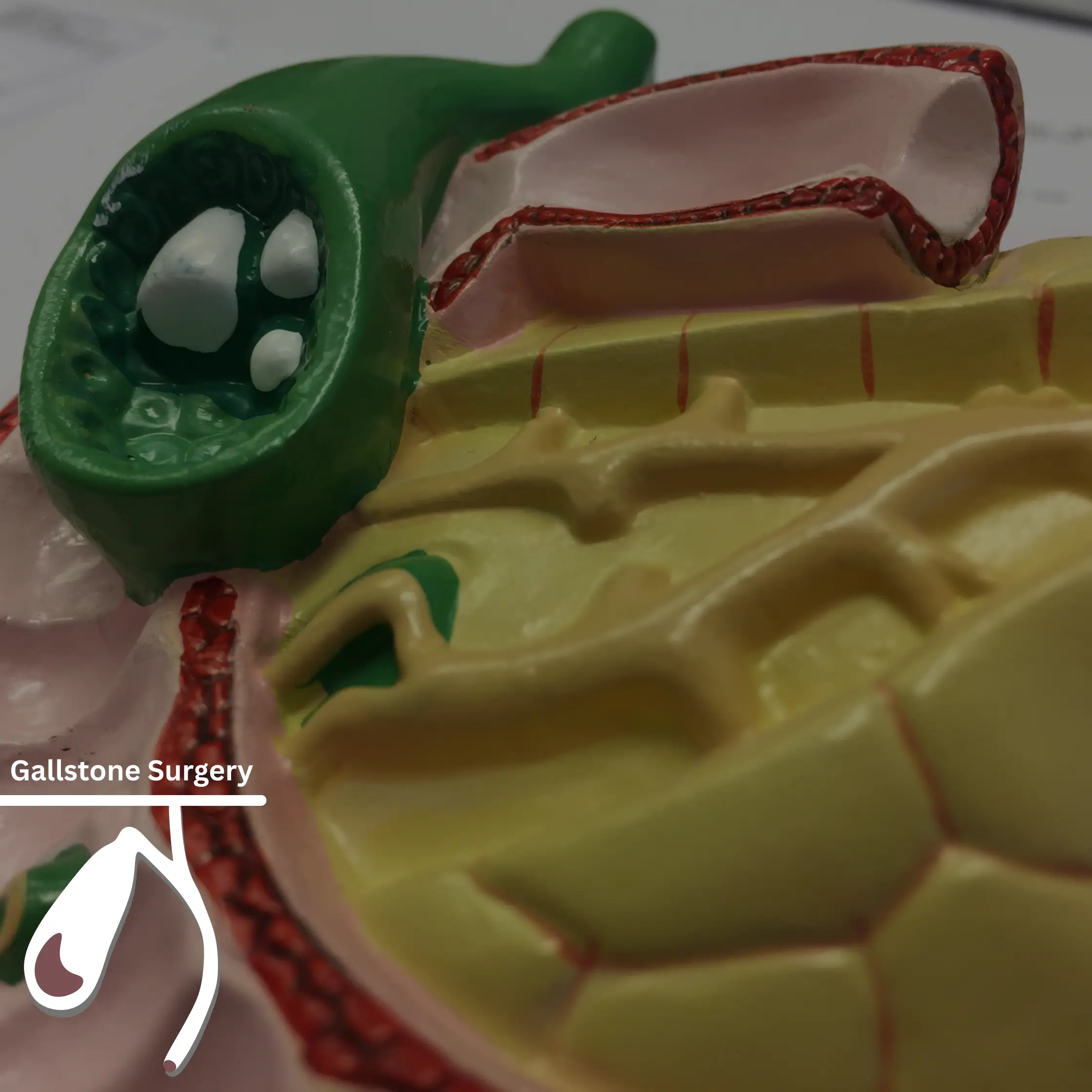 5 Essential Tips to Prepare for Gallstone Surgery