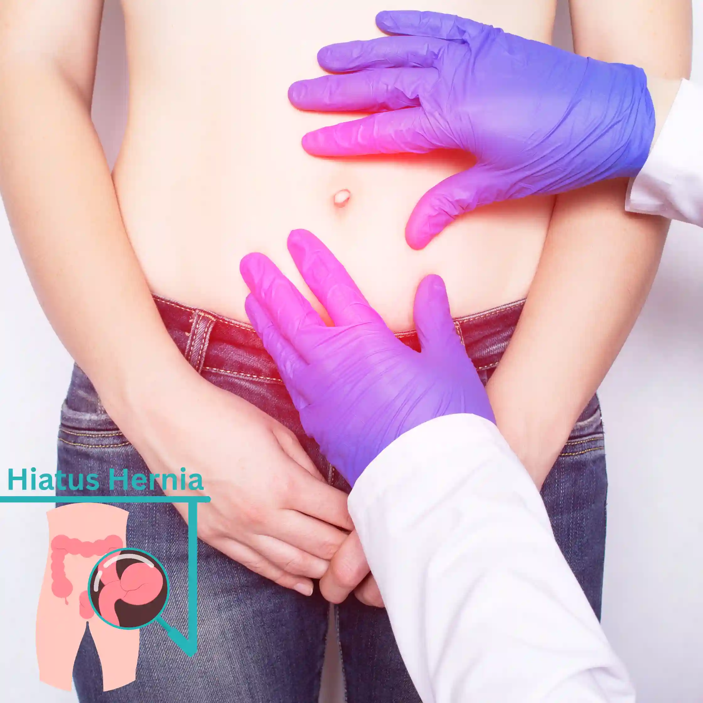 Understanding Hiatus Hernia: Causes, Symptoms, and Treatment