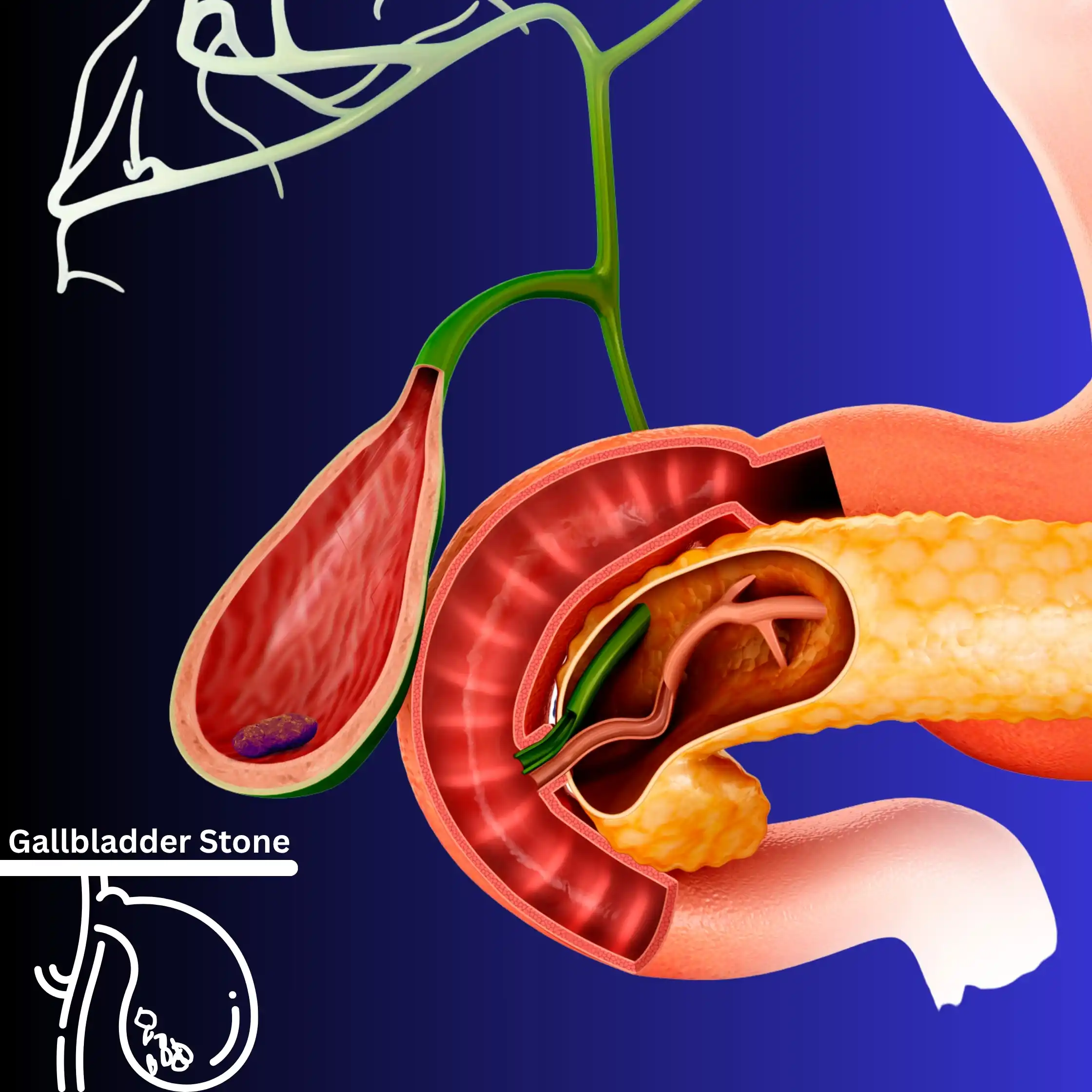 Gallbladder Stone Symptoms: Is It Just Gas or Something Serious? | Dr. Rajesh Sinha Raipur